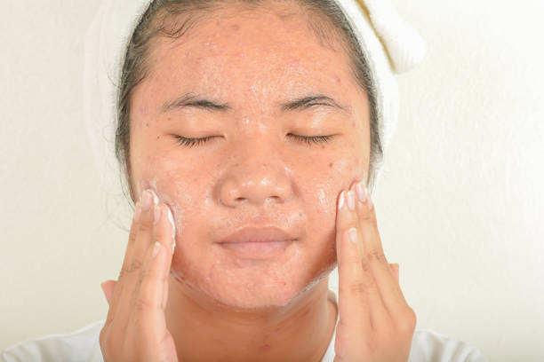 istock Facial wash  with acne 820810082