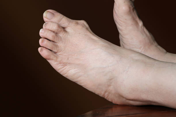 istock Bunion - hallux valgus on brown background 821169198