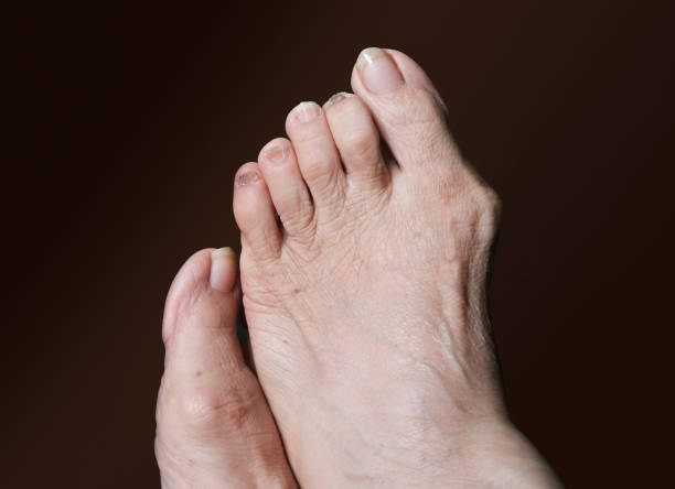 istock Bunion - hallux valgus on brown background 821169200