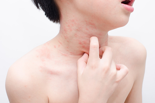 Young asian child skin with rash over white background