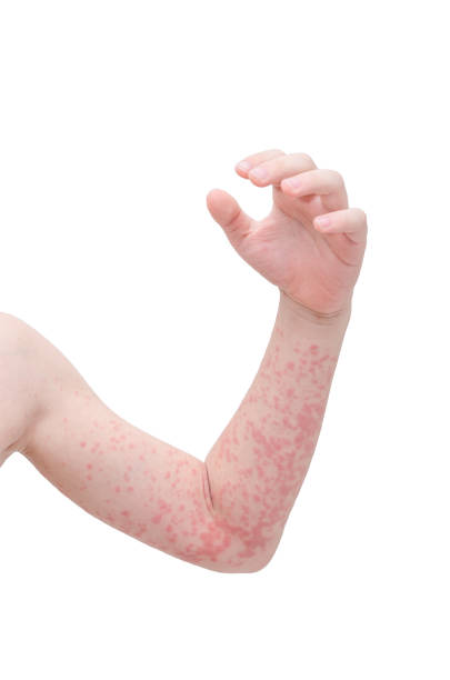 istock child skin with rash 821179868