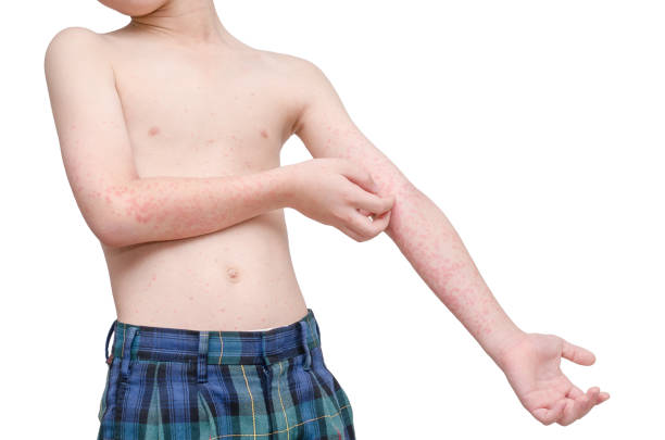 child skin with rash stock photo