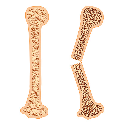 Healthy bone and broken bone with osteoporosis on the white background.