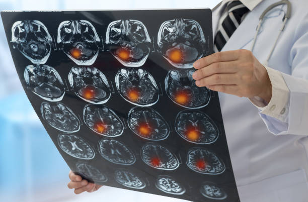 brain scan Brain tumor or Stroke Cerebrovascular. Doctor examines the MRI scan brain x-ray image of the patient. brain tumour photos stock pictures, royalty-free photos & images
