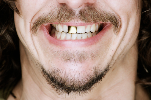 Patient with gingival smile, large gums and small teeth, microdentia, close-up.