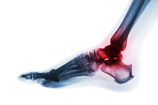 Artritis del tobillo. Radiografía del pie. Vista lateral. Invertir color estilo. Gota o reumatoide concepto photo