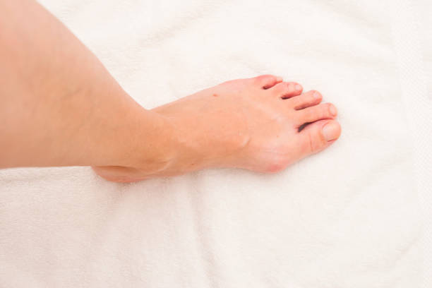 piede femminile sinistro con hallux valgus - human foot bunion pain human toe foto e immagini stock