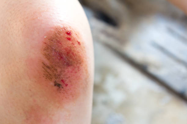 istock Bruised wound injury on woman knee background 822738684