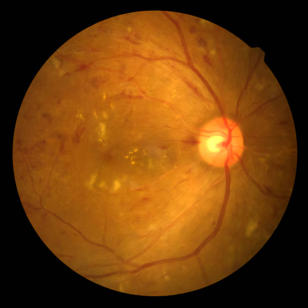 foto retina pazza anormale isolata su sfondo nero. retina del diabete diabates retinopatia. - vein field foto e immagini stock