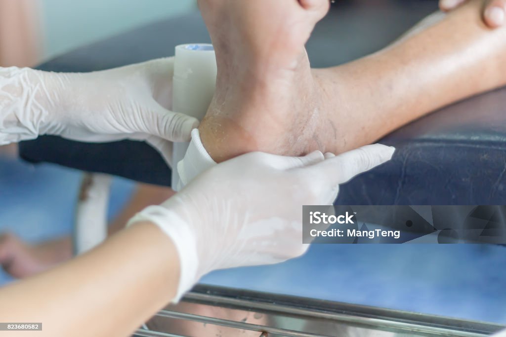 infected wound of diabetic infected wound of diabetic foot Wound Stock Photo