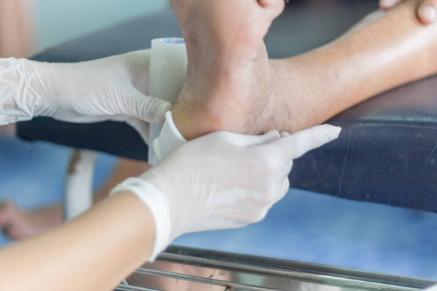infected wound of diabetic infected wound of diabetic foot ulcer stock pictures, royalty-free photos & images