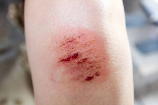 Bruised wound injury on woman knee background Bruised wound injury on woman knee background skin scrape stock pictures, royalty-free photos & images