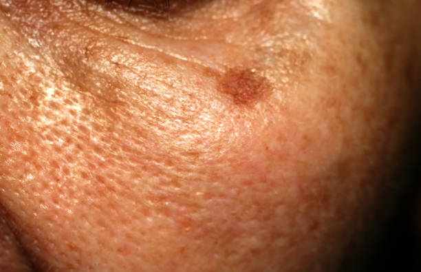 istock Brown stain on the face. Pigmentation on the skin 824962932