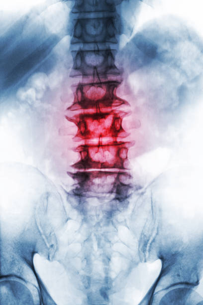 espondilosis.  columna de cine radiografía lumbosacra de viejos años paciente mostrar osteofitos, colapso de la espina dorsal del proceso degenerativo. vista frontal - haunch fotografías e imágenes de stock