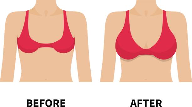 Female breast before and after plastic surgery Vector illustration of a small chest and big in a red bra. Isolated white background. Female breast before and after plastic surgery. Flat style. silicone implants stock illustrations