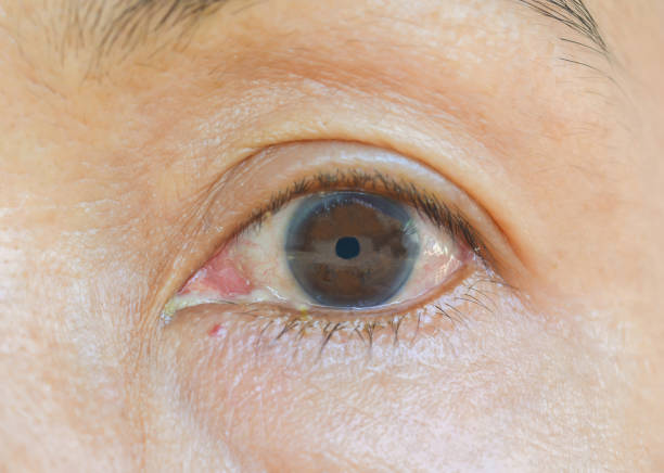 Eyes with chemical allergies