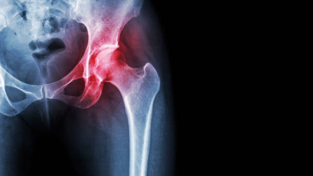 arthritis im hüftgelenk. der roentgenfilm zeigen entzündeten hüftgelenks und leeren bereich auf der rechten seite. femurkopfnekrose konzept - haunch stock-fotos und bilder