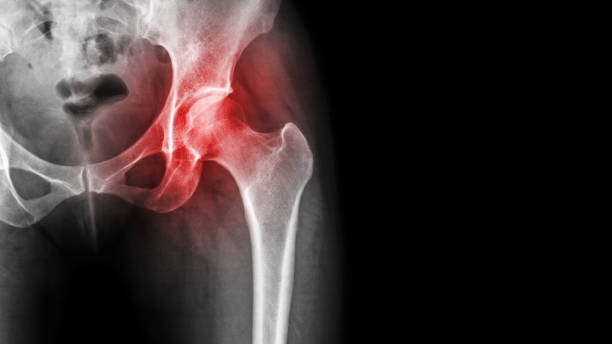 artritis en la articulación de la cadera. rayos x de la película muestran inflamación de la articulación de la cadera y la zona en blanco en el lado derecho. concepto de necrosis avascular - rheumatic fotografías e imágenes de stock