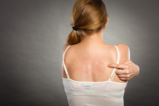 Health problem, skin diseases. Young woman showing her itchy back with allergy rash urticaria symptoms