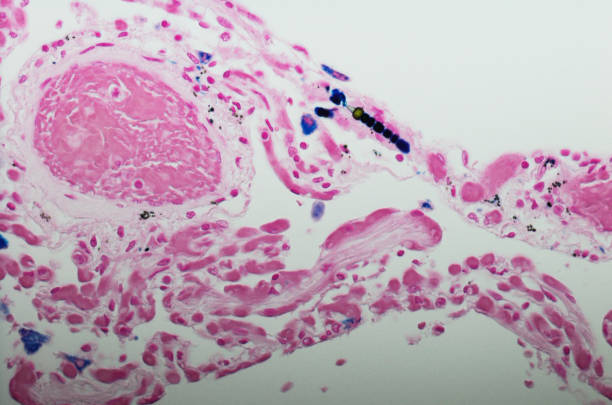 Ferruginous bodies are typically indicative of asbestos inhalation (when the presence of asbestos is verified they are called \
