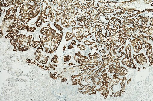 Micrograph of Pleural Mesothelioma. Mesothelioma is a rare, aggressive form of cancer that primarily develops in the lining of the lungs (pleural mesothelioma). Caused by asbestos, mesothelioma has no known cure and has a poor prognosis. Generally, the earlier mesothelioma is diagnosed, the better prognosis a patient has.  CK5/6 immunostain
