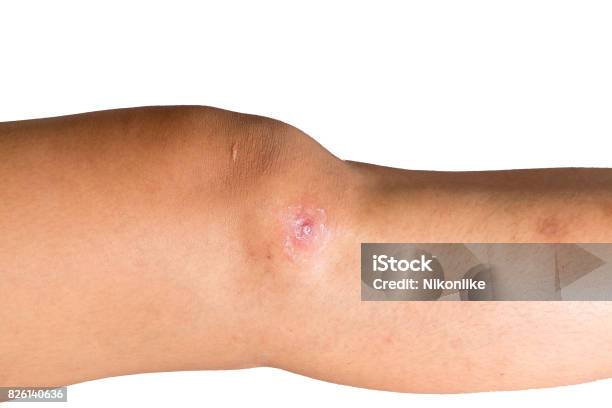 Wound On Skin Stock Photo - Download Image Now - Anatomy, Blood, Blowing