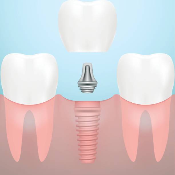 istock Human Teeth And Dental Implant Isolated On A Background. Vector Illustration 826175106