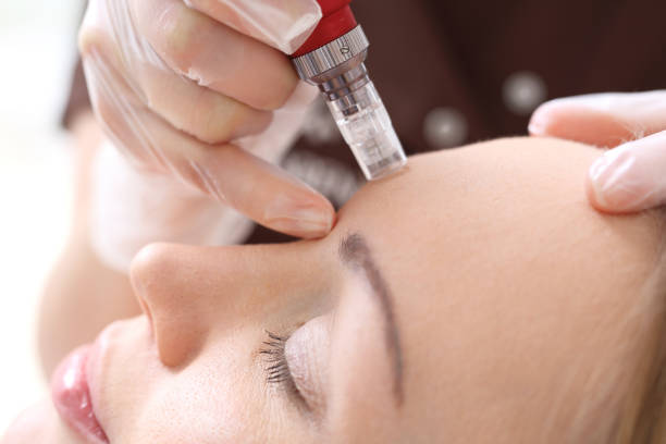 Needle mesotherapy treatment aesthetic execution in the beauty salon Mesotherapy microneedle, the woman at the beautician beauty treatments stock pictures, royalty-free photos & images