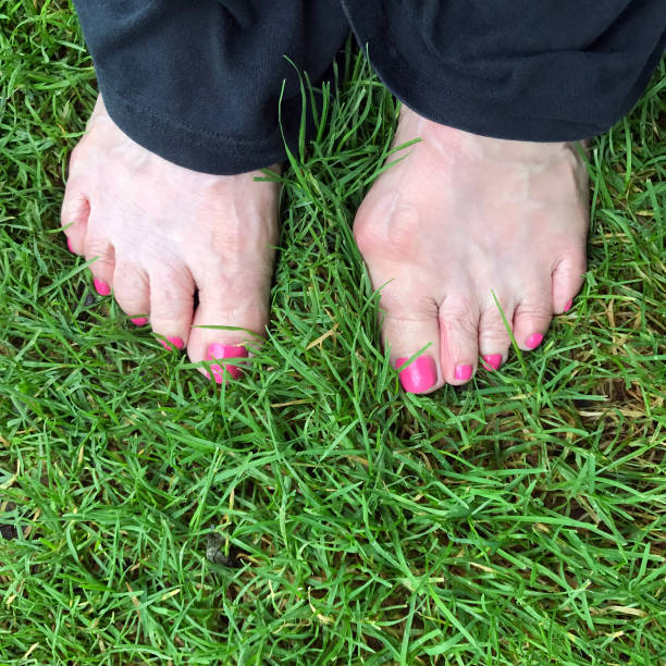 istock Two Feet in Grass and Bunion 827740364