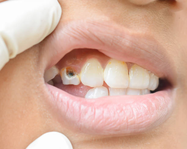 abgebrochene zähne bei kindern - zahnkaries stock-fotos und bilder