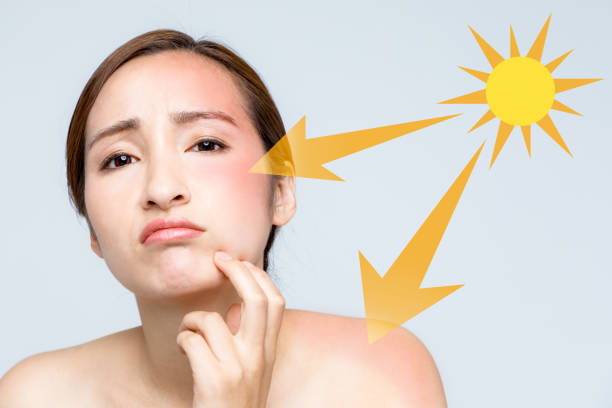 young woman with a bad sunburn on her face young woman with a bad sunburn on her face skin diagram photos stock pictures, royalty-free photos & images