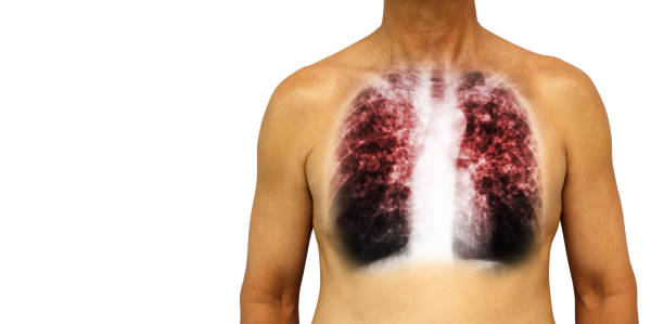 gruźlica płuc . ludzka klatka piersiowa z x-ray show śródmiąższowy naciek obu płuc z powodu infekcji . izolowane tło . pusty obszar po lewej stronie - interstitial zdjęcia i obrazy z banku zdjęć