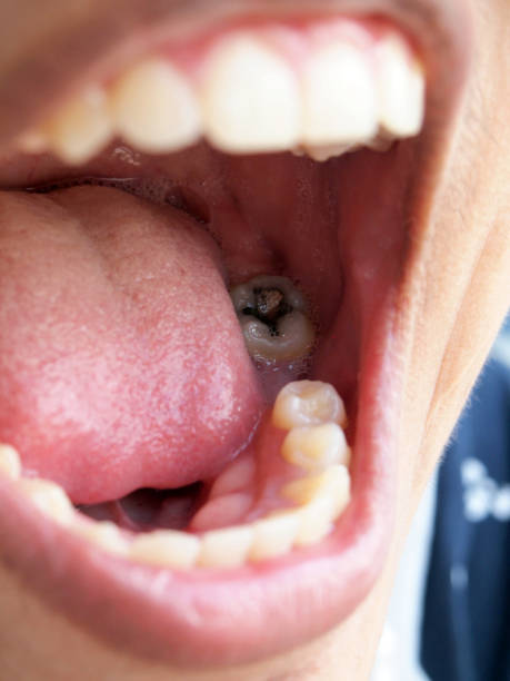 istock Human teeth with cavity needing treatment photographed from a rare angle 829605560