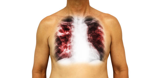 pulmonary tuberculosis . human chest with x-ray show cavity at right upper lung and interstitial infiltrate both lung due to infection . isolated background - human upper body xray imagens e fotografias de stock