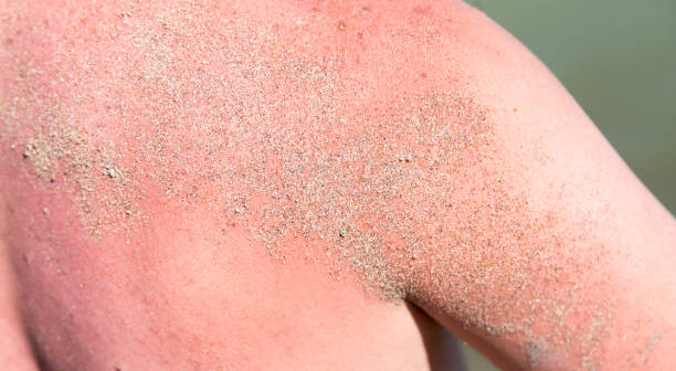 istock Red skin tan on the back of a man 831020492