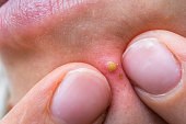 Woman squeezing pimple with two fingers on her face