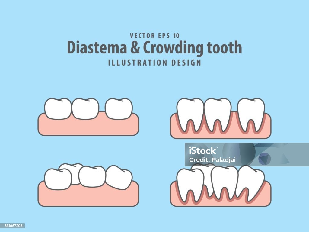 Diastema y la apretadura de dientes vector ilustración sobre fondo azul. Concepto dental. - arte vectorial de Dientes libre de derechos