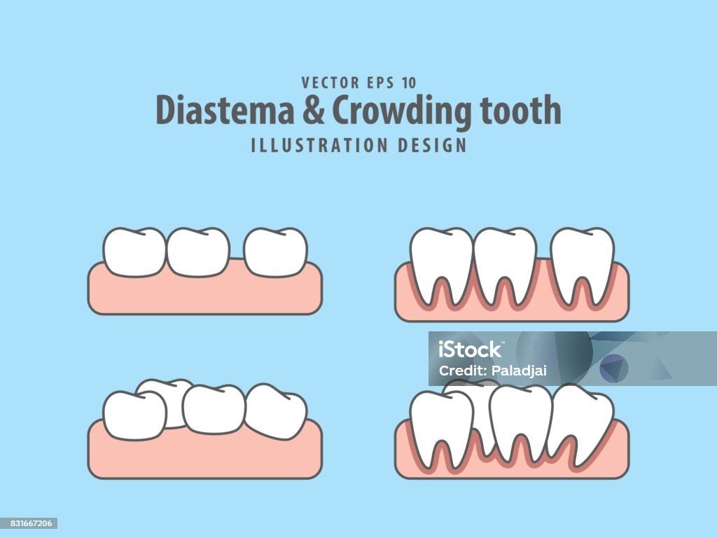 Diastema & Crowding tooth illustration vector on blue background. Dental concept. Teeth stock vector