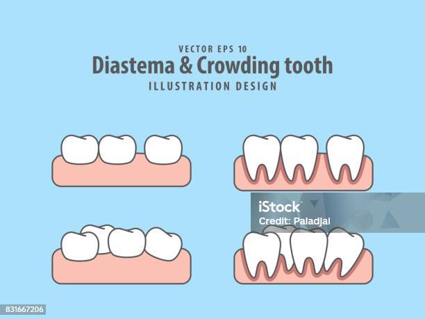 Diastema Crowding Tooth Illustration Vector On Blue Background Dental Concept Stock Illustration - Download Image Now