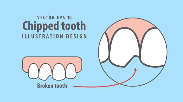 Chipped tooth illustration vector on blue background. Dental concept. Chipped tooth illustration vector on blue background. Dental concept. peeling off stock illustrations