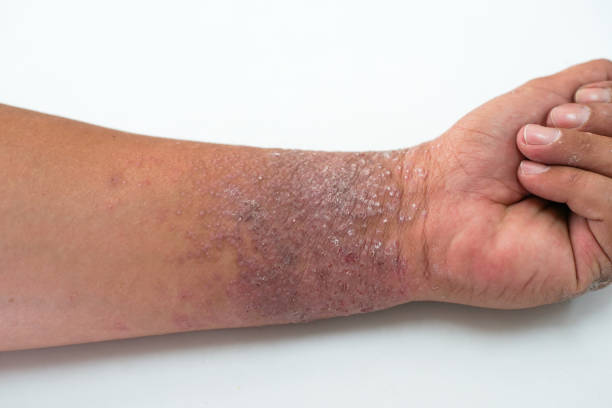 istock Eczema presents on the hand and palms 831839602