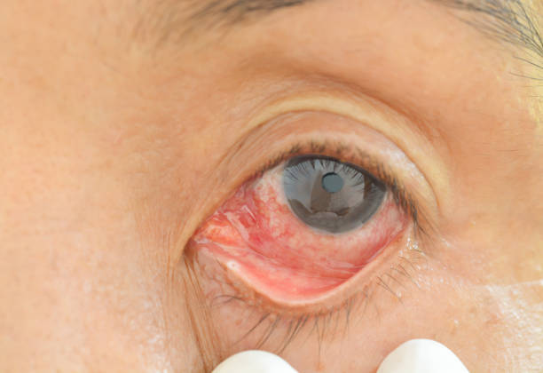 istock Eyes with chemical allergies 831897194