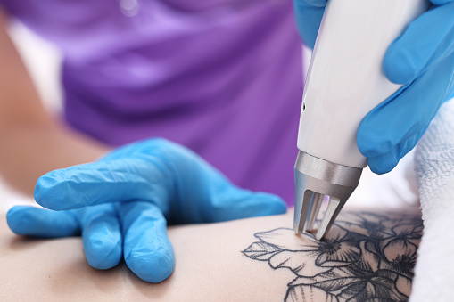 Laser tattoo removal in the clinic of aesthetic medicine.