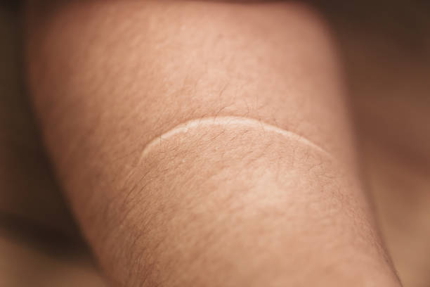 keloid. hässliche frauen arm haut narbe von messer schneiden wunde - scar stock-fotos und bilder