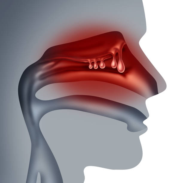 Nasal Polyps Nasal polyps medical concept as noncancerous swelling and growth as a human sinuses congestion symptom symbol in a 3D illustration style. nose stock pictures, royalty-free photos & images