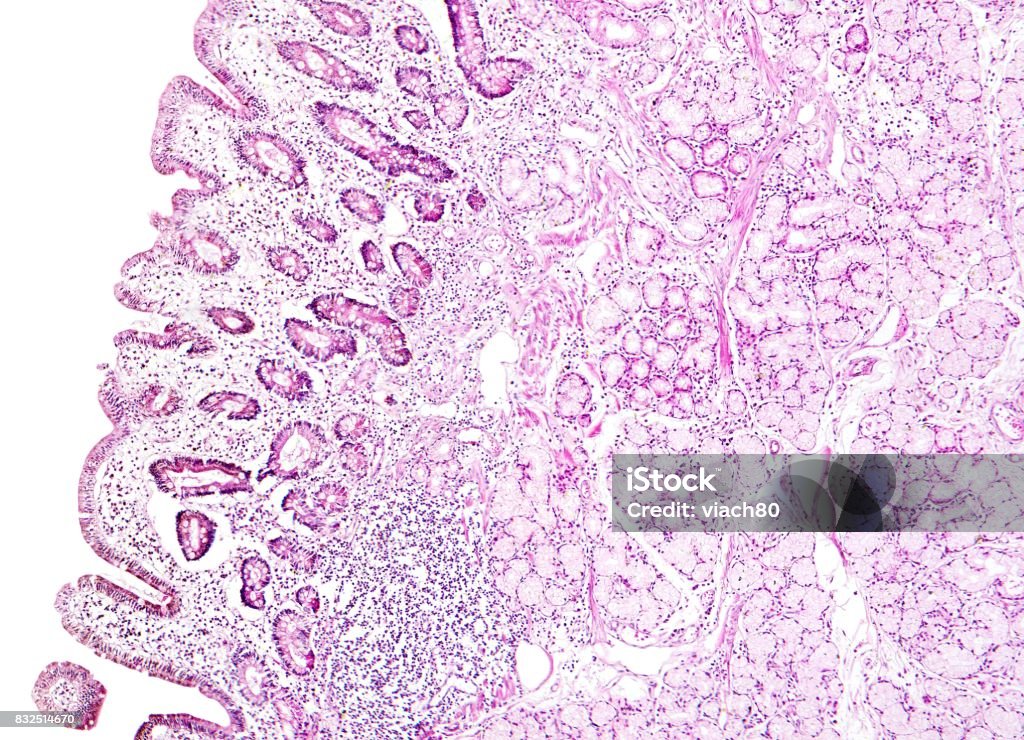 Histology of human tissue, show gastric mucosa intestinal metaplasia as seen under the microscope Histology of human tissue, show gastric mucosa intestinal metaplasia as seen under the microscope, 10x zoom. Anatomy Stock Photo