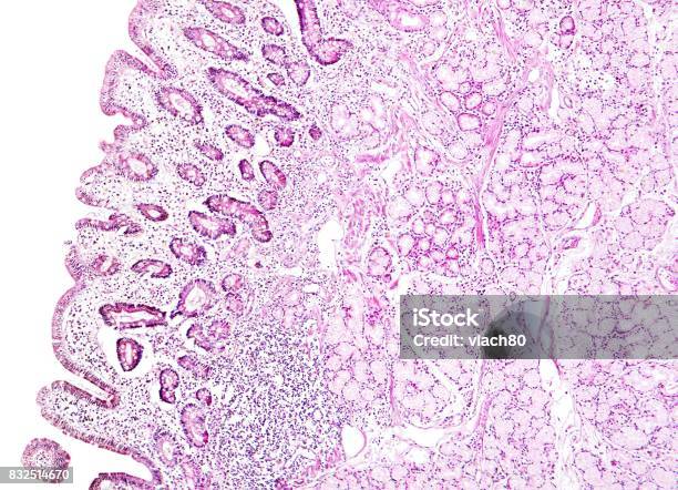 Histology Of Human Tissue Show Gastric Mucosa Intestinal Metaplasia As Seen Under The Microscope Stock Photo - Download Image Now