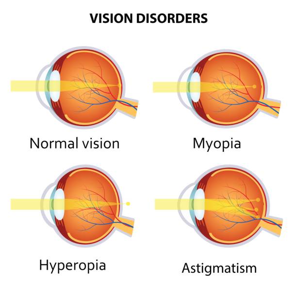 Common vision disorders. Common vision disorders. Astigmatism, Myopia and Hyperopia myopia stock illustrations