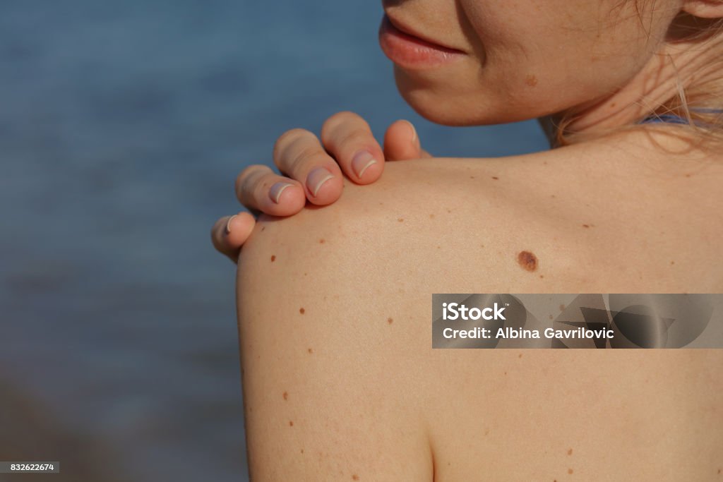 Control de lunares benignos: hermosa mujer con marcas de nacimiento en su espalda y cara. Eliminación de etiquetas de piel con láser - Foto de stock de Lunar libre de derechos