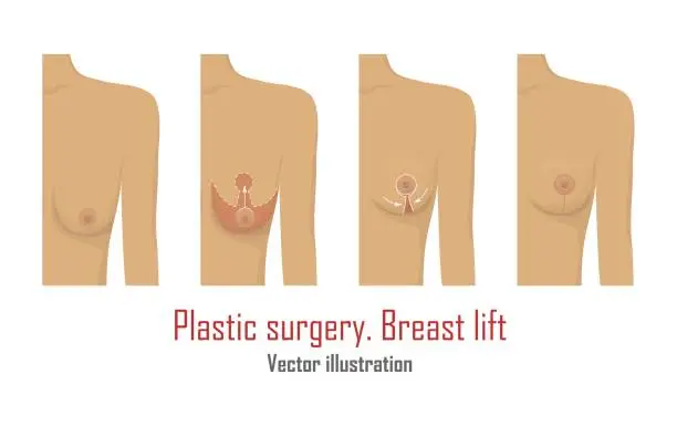 Vector illustration of Lifting breast plastic surgery